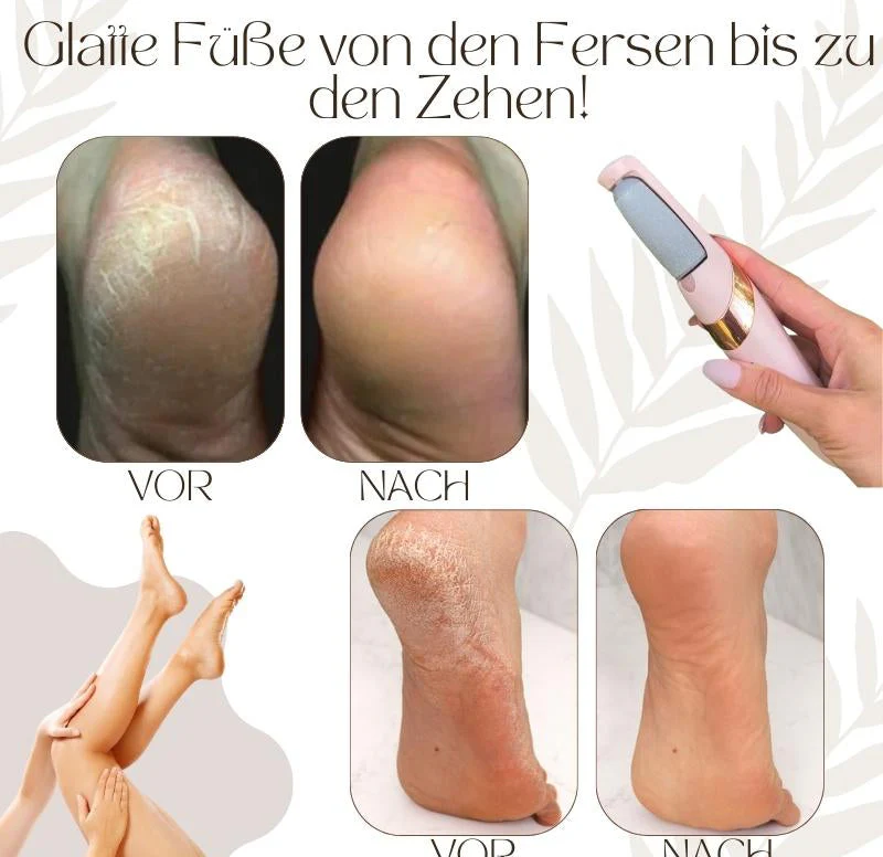 CallusPro™ - Electric Callus Remover - Image 7
