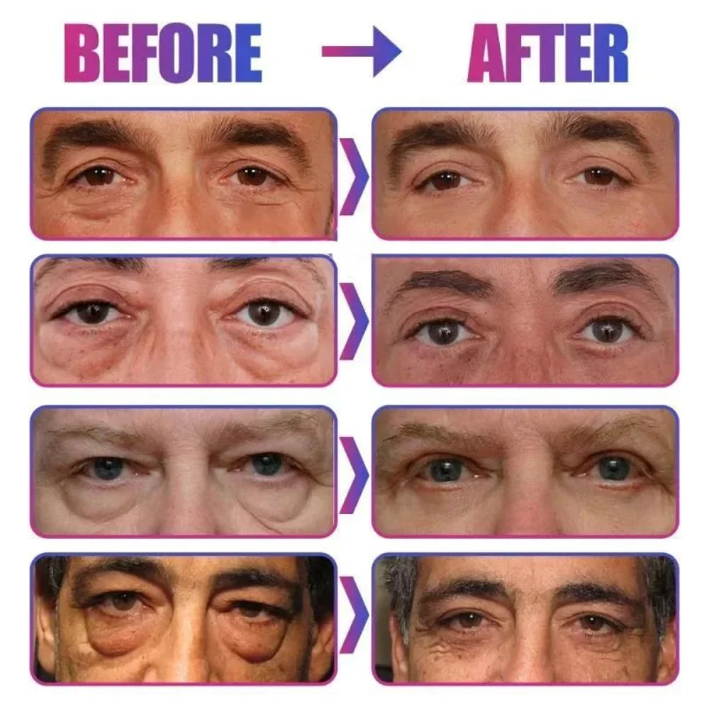 Eye Bag Remove Cream | Puffiness And Dark Circle Care | Smooth Under Eye Finish | EyeRenew - Image 7