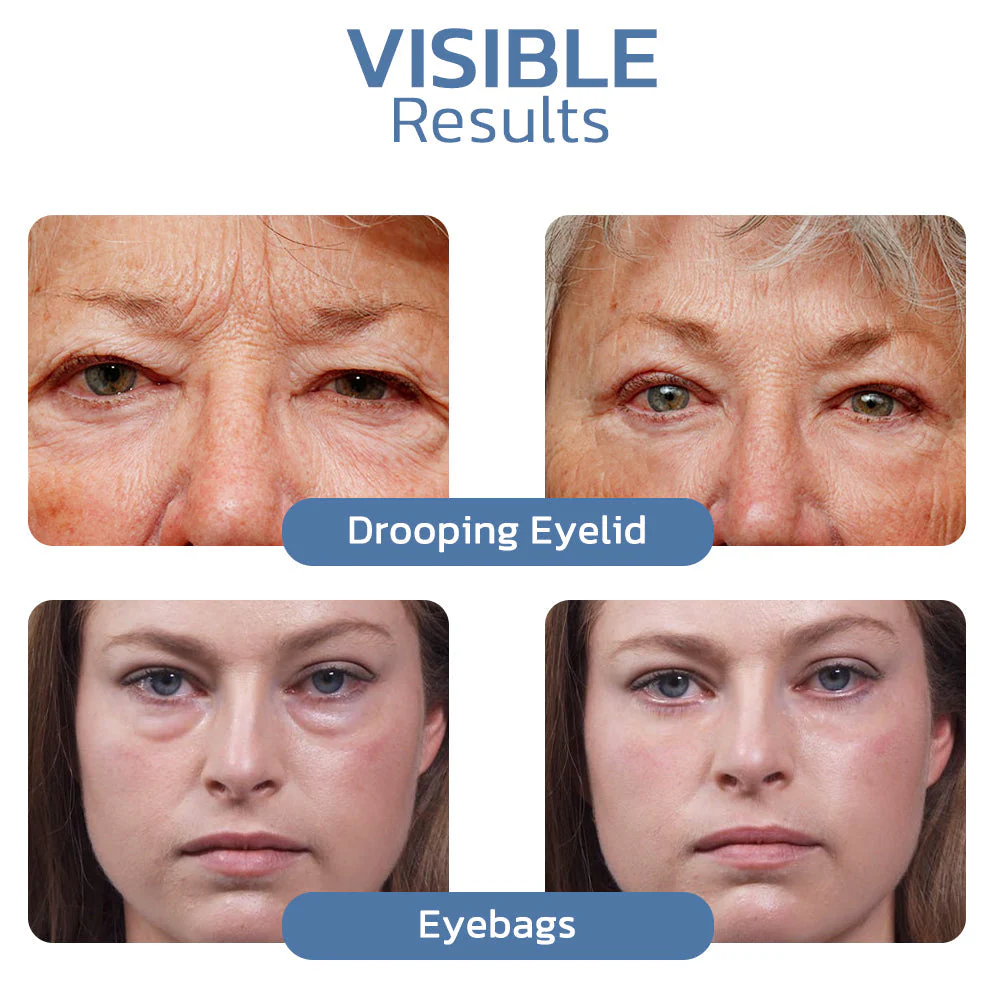 Eye Lifting Gel | Peptide Formula | Reduces Puffiness | Firming Effect | LumiLift - Image 4