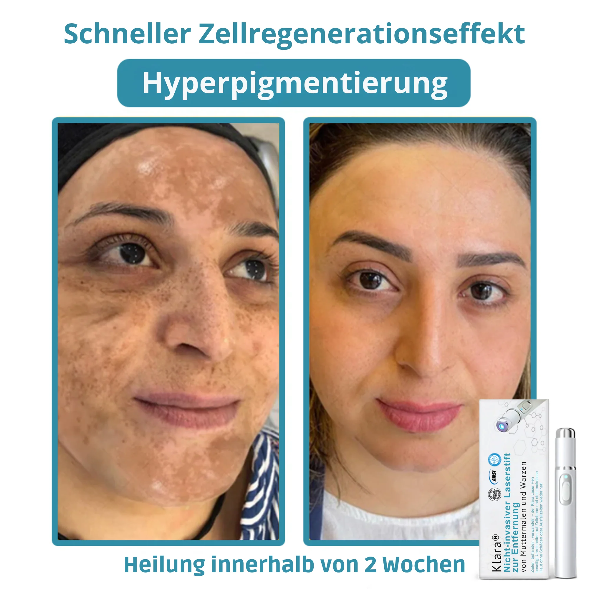 Klara™ Painless Laser Pen — Reveal Flawless Skin And Confidence Anytime - Image 10