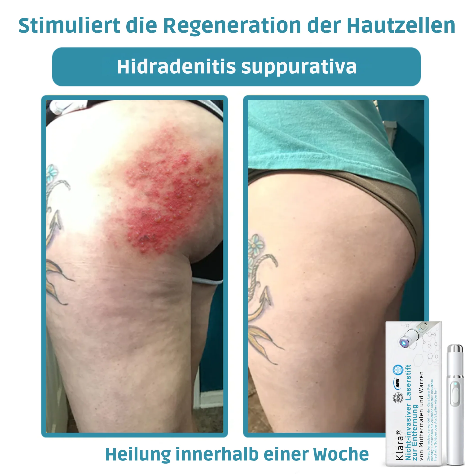 Klara™ Painless Laser Pen — Reveal Flawless Skin And Confidence Anytime - Image 11