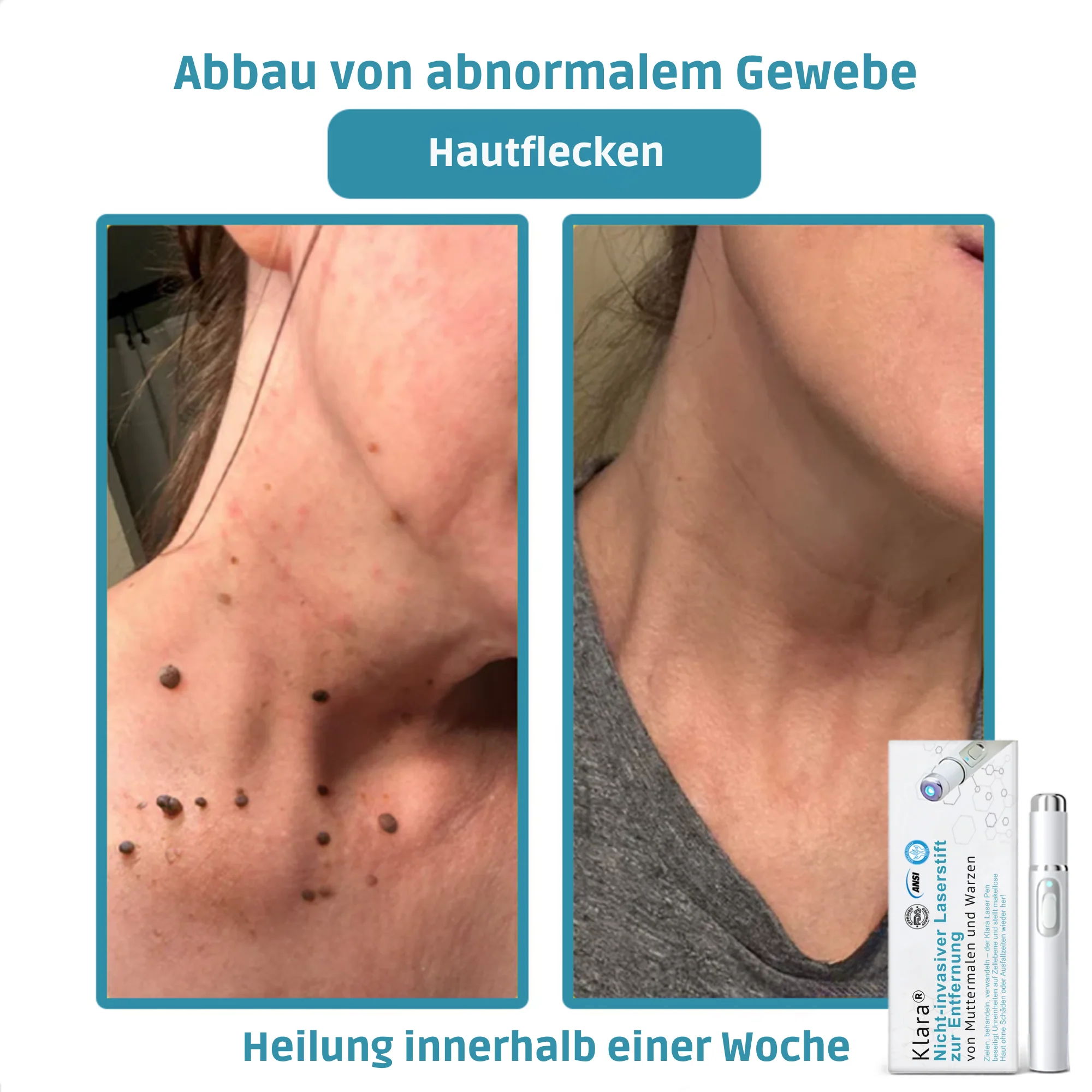 Klara™ Painless Laser Pen — Reveal Flawless Skin And Confidence Anytime - Image 5
