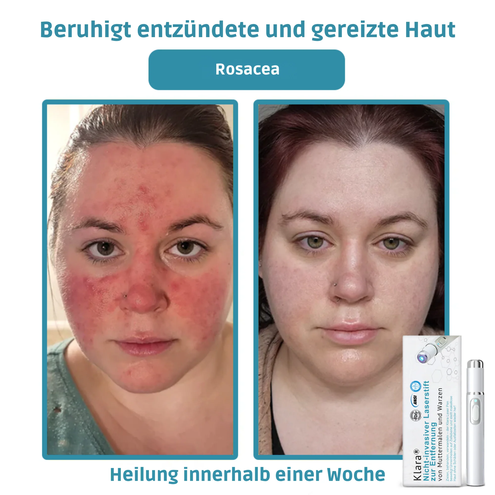 Klara™ Painless Laser Pen — Reveal Flawless Skin And Confidence Anytime - Image 7