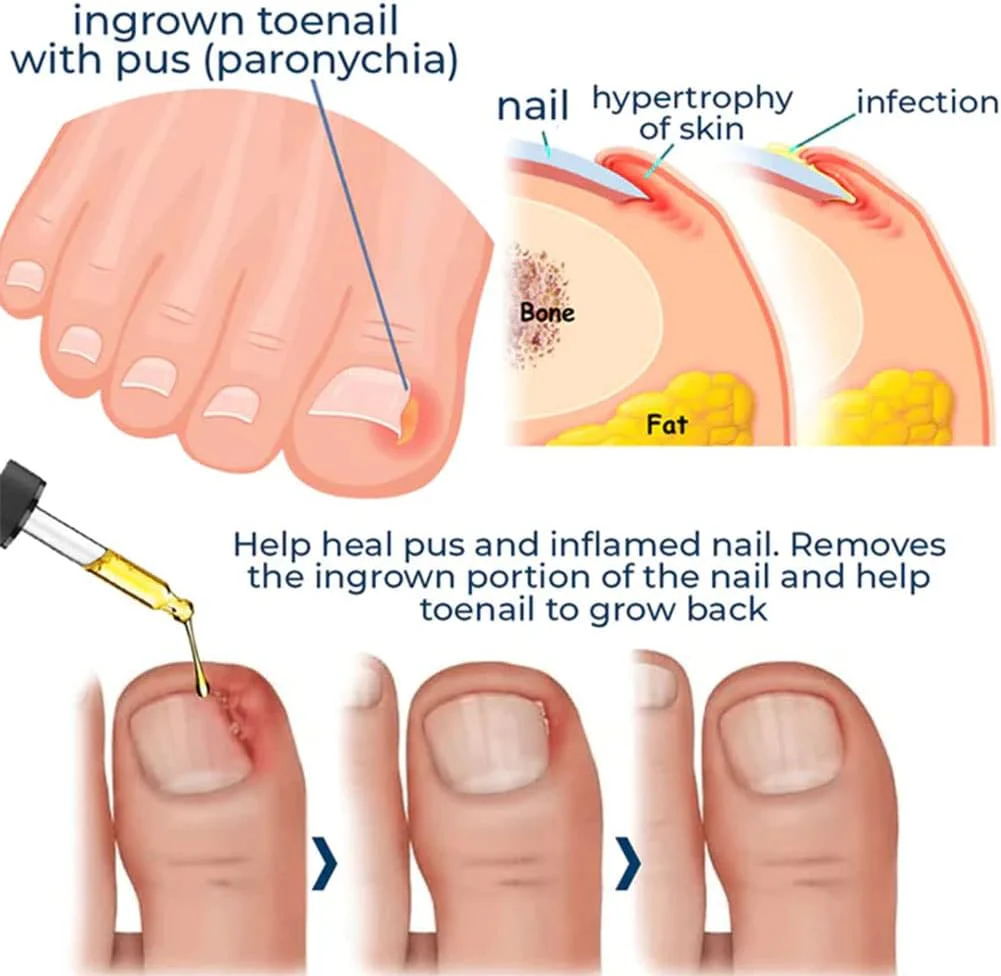 Nail Care Serum | Brittle Nail Repair | Visible Results in 4 Weeks | Easy Daily Use | HealNail - Image 5