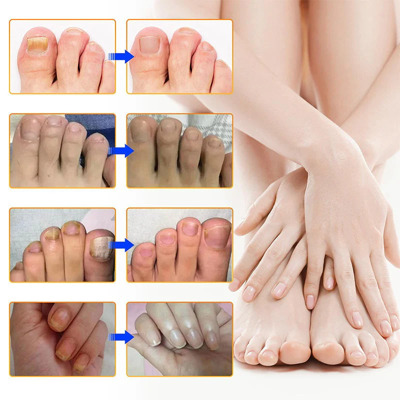 Nail Fungus Patches | Antifungal Nail Care | Overnight Repair | Nailox - Image 7