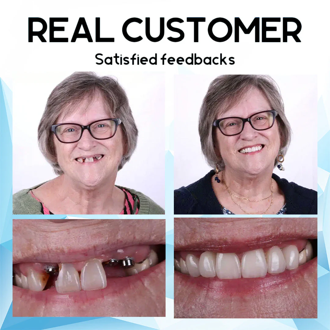 Silicone Reline Denture Set | Secure Denture Fit | BrightFit Veneer - Image 3
