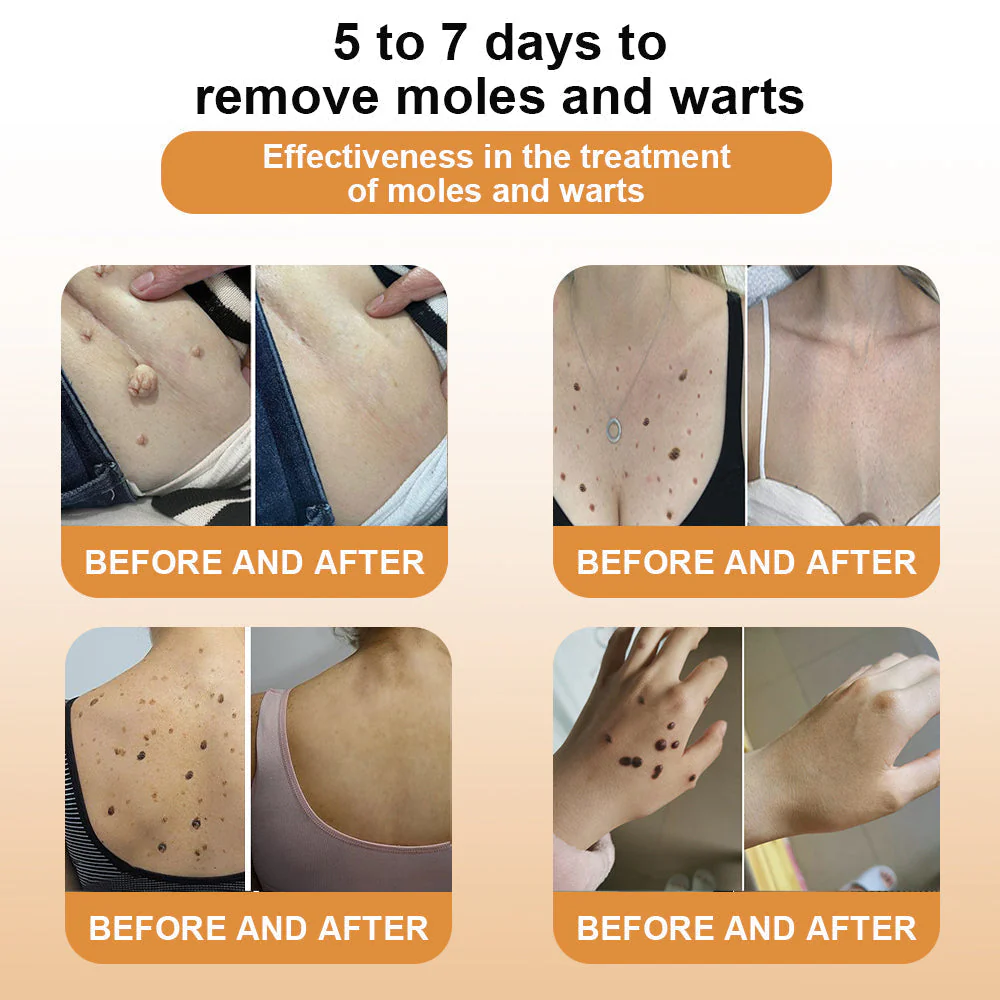 Skin Tag Remover | Bee Venom Formula | Painless Use | NewYou - Image 2
