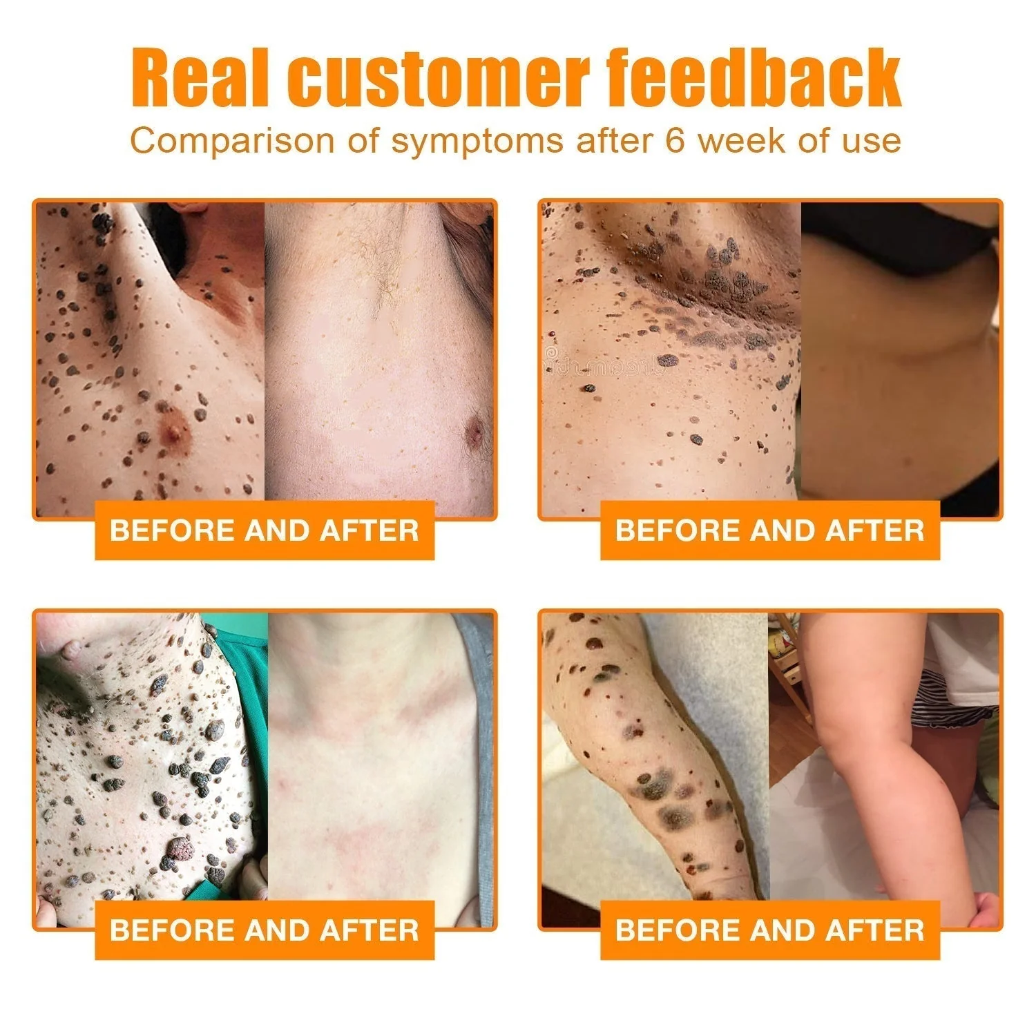 Skin Tag Remover | Bee Venom Formula | Painless Use | NewYou - Image 3