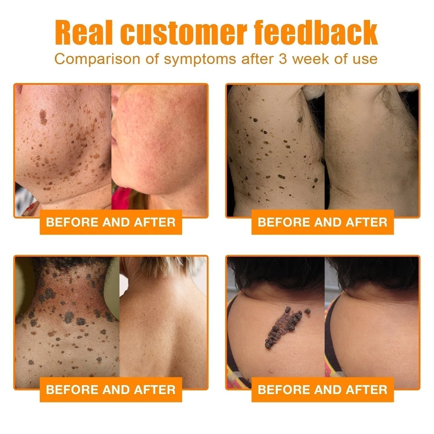 Skin Tag Remover | Bee Venom Formula | Painless Use | NewYou - Image 5