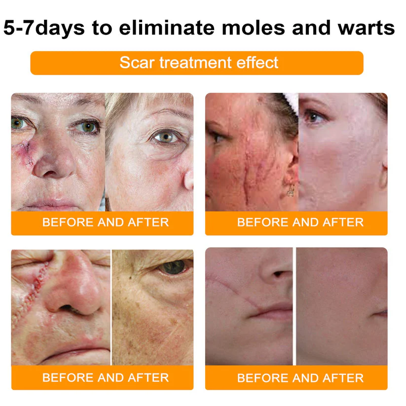 Skin Tag Remover | Bee Venom Formula | Painless Use | NewYou - Image 6