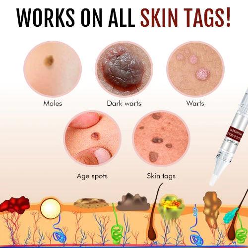 Skin Tag Remover | Fast-Acting Formula | Painless Application - Image 4