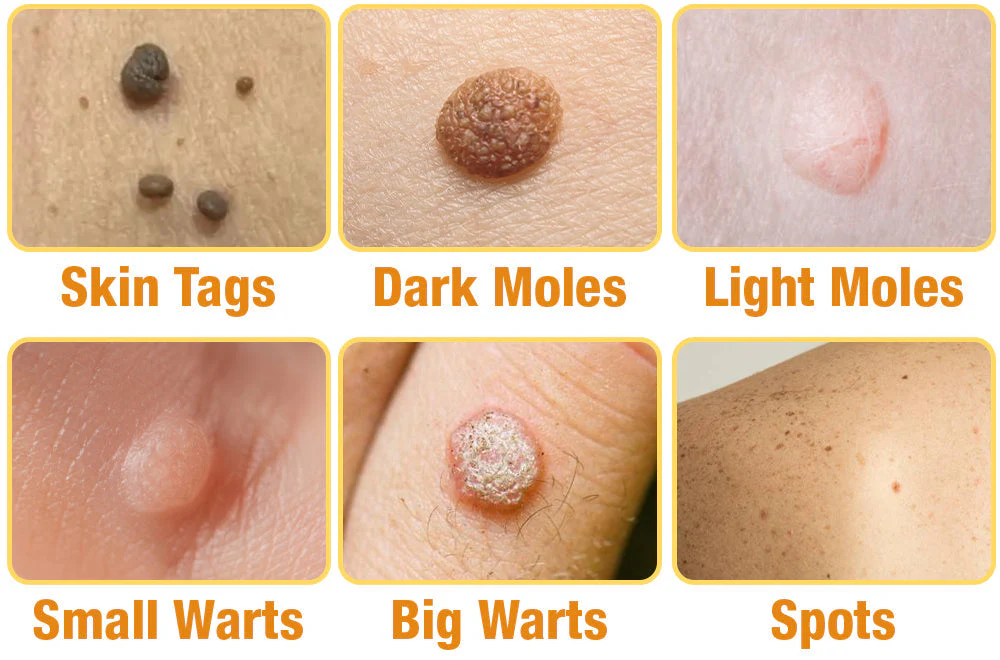 Wart Removal Spray | Bee Venom Formula | Gentle Skin Repair - Image 6